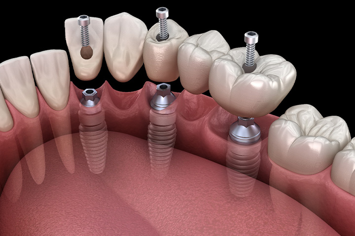 A computer design showing an implant bridge.