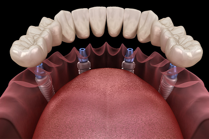 A computer design showing an implant denture.
