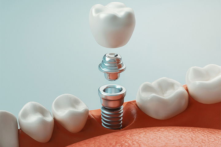 A computer design showing the parts of a dental implant.