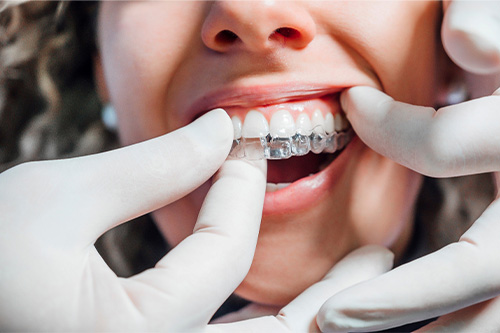 Dentist putting clear aligner on patient.