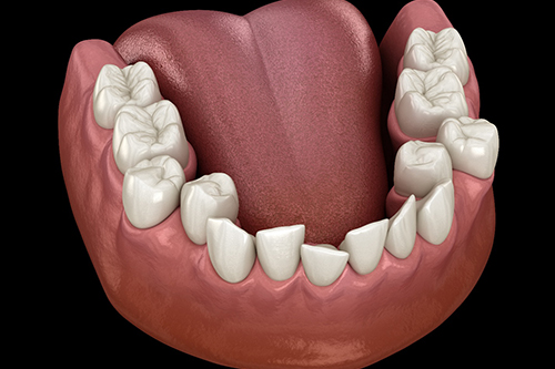 Illustration of crooked teeth