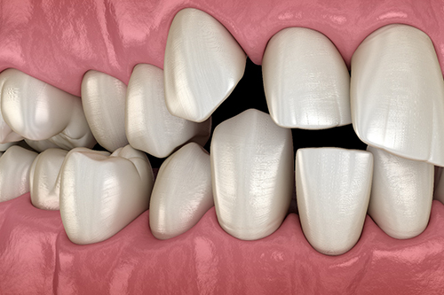 Illustration of gapped teeth