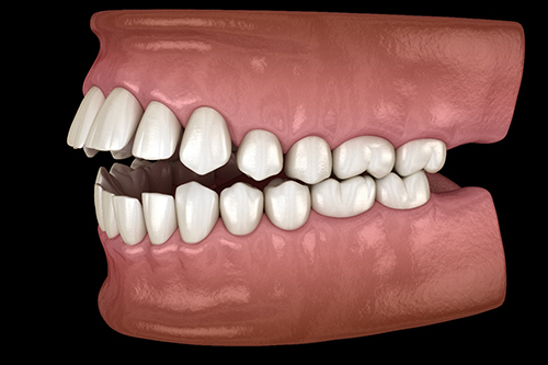 Illustration of an open bite