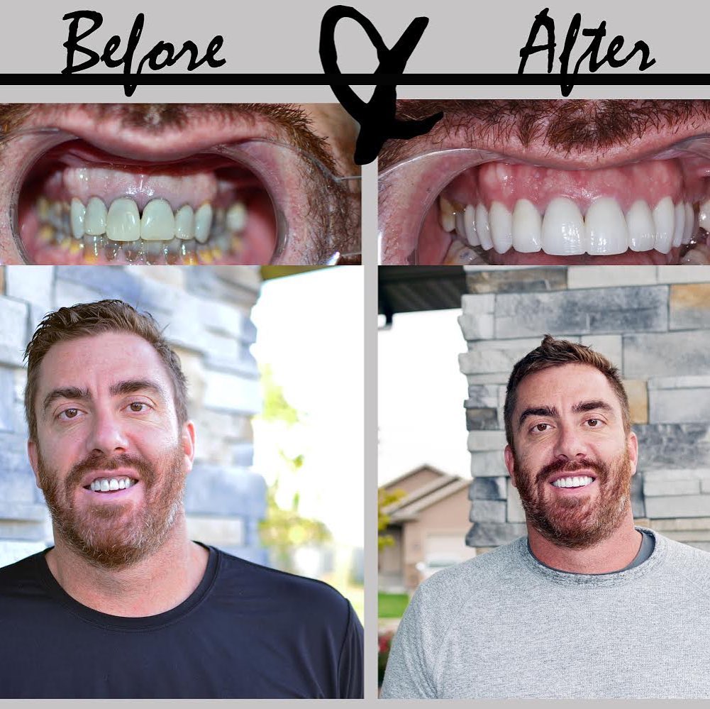 Before and after pictures of bearded man's smile