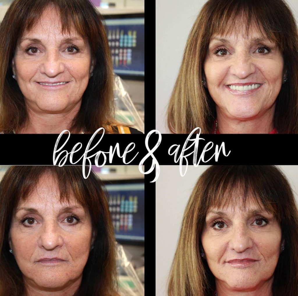 Long haired woman's smile before and after dental work