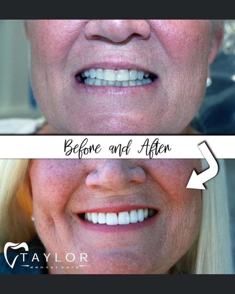 Close up of woman's smile before and after treatment