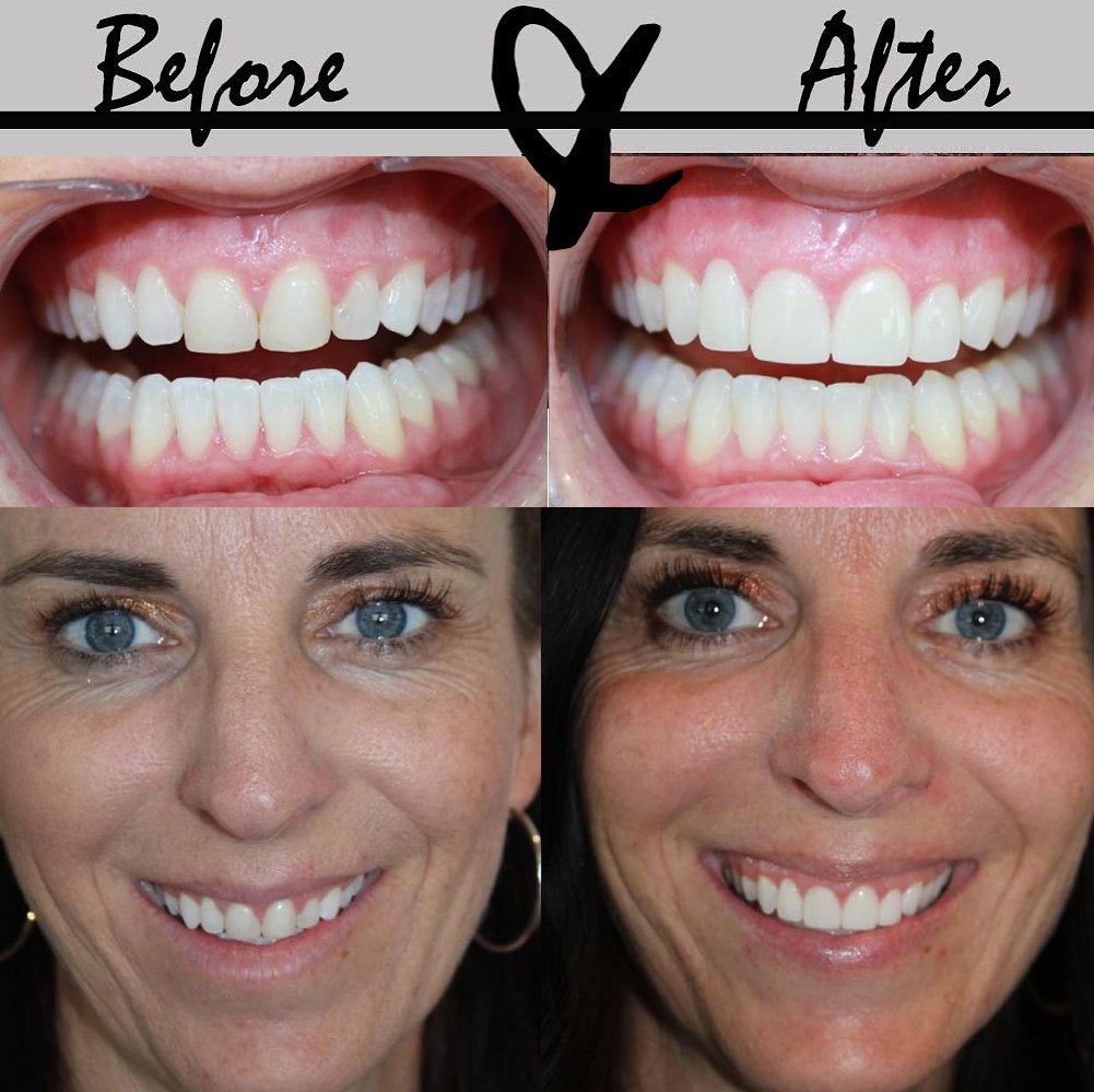 Mature woman's smile prior to and following dental treatment