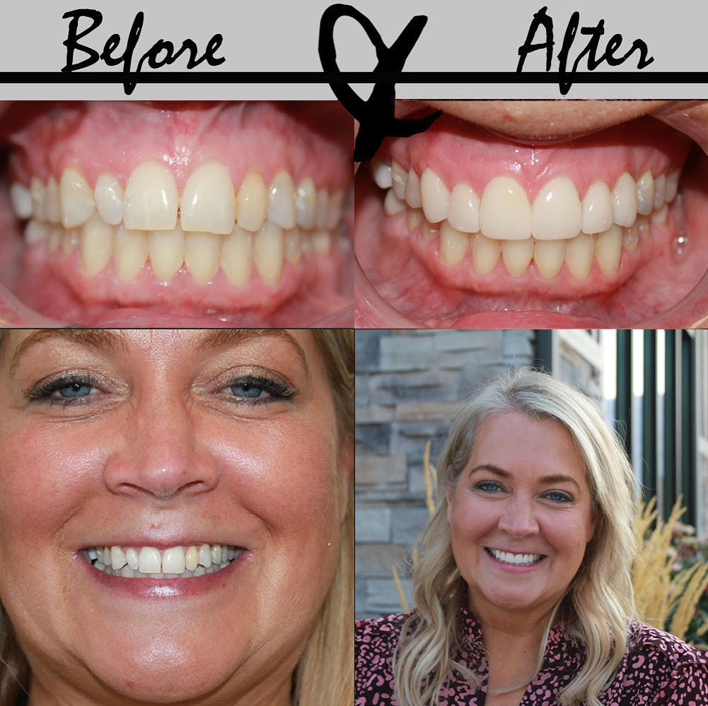 Woman's smile before and after having gap between front teeth closed