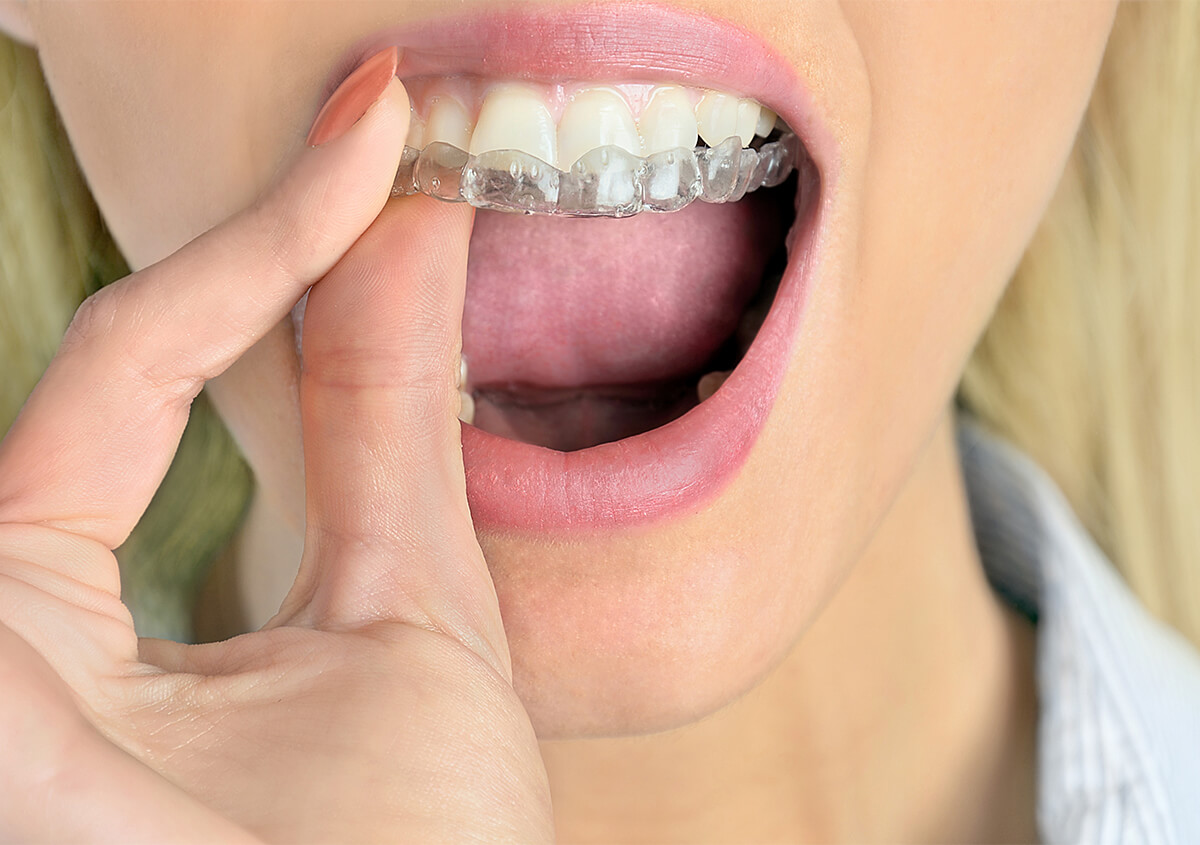 Teeth Straightening With Invisalign in Sandy UT Area
