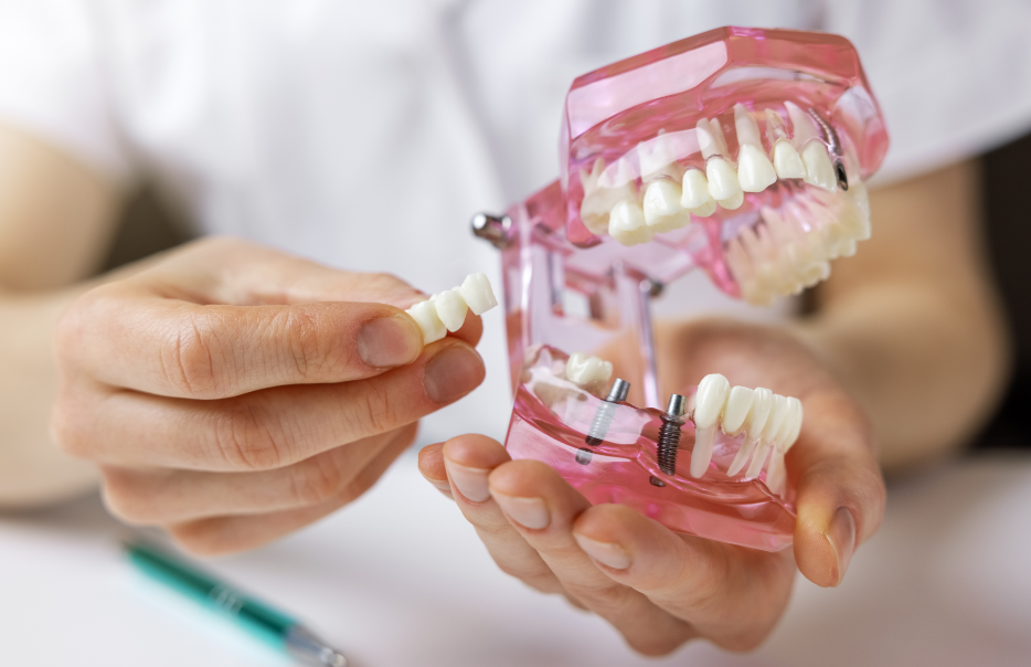 Dentist holding dental implant model
